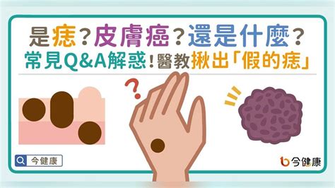 為什麼會長痣|是痣？還是皮膚癌？皮膚科醫師教你揪出「假的痣」，。